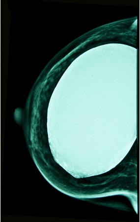 Example of breast with implant x-ray image 