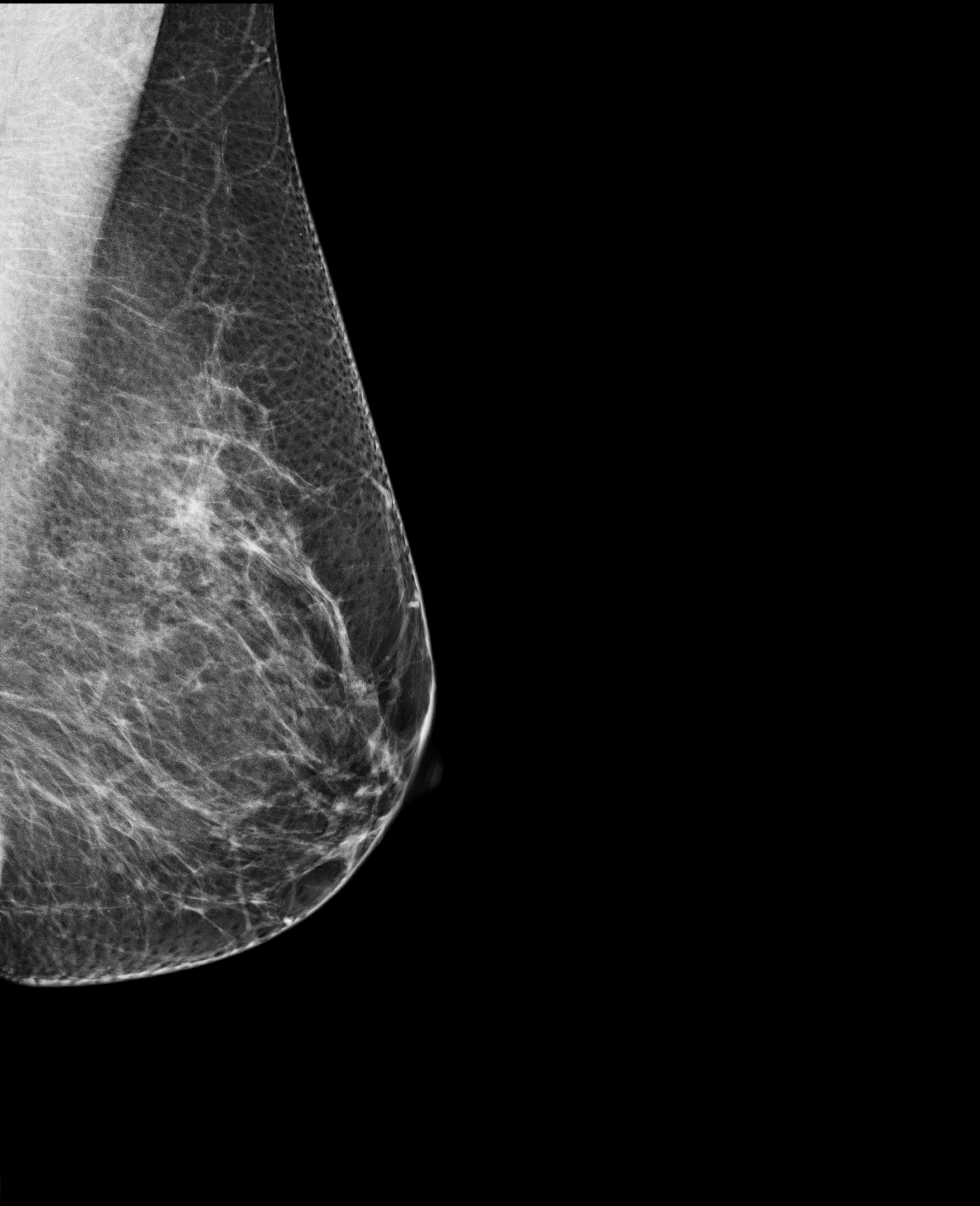 Example of an x-ray image of a breast